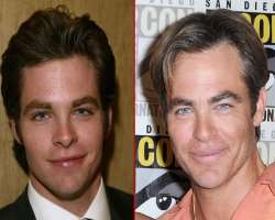 Chris Pine before surgery